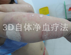 成都银康银屑病医院 怎样治疗牛皮癣